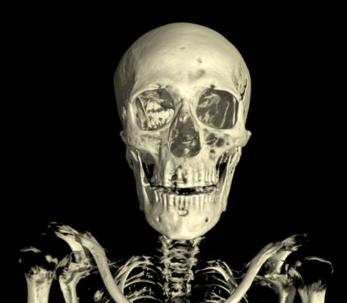 The CT scan of the skull of the mummy of an adult man (name unknown). The scan shows considerable evidence of dental abcesses and the loss of several teeth. © Trustees of the British Museum.