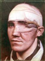Percy Hennell. Probable shotgun wound of left eye which has been lost. Tissue has been replaced by a flap of skin from forehead or scalp, hence the bandage around the head where the flap was raised. Antony Wallace Archive, British Association of Plastic, Reconstructive and Aesthetic Surgery.